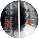 degenerative-disc