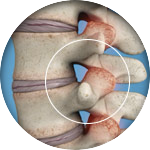 facet-joint-syndrome-circle