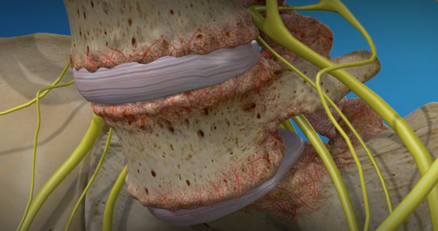 Spondylolisthesis-2