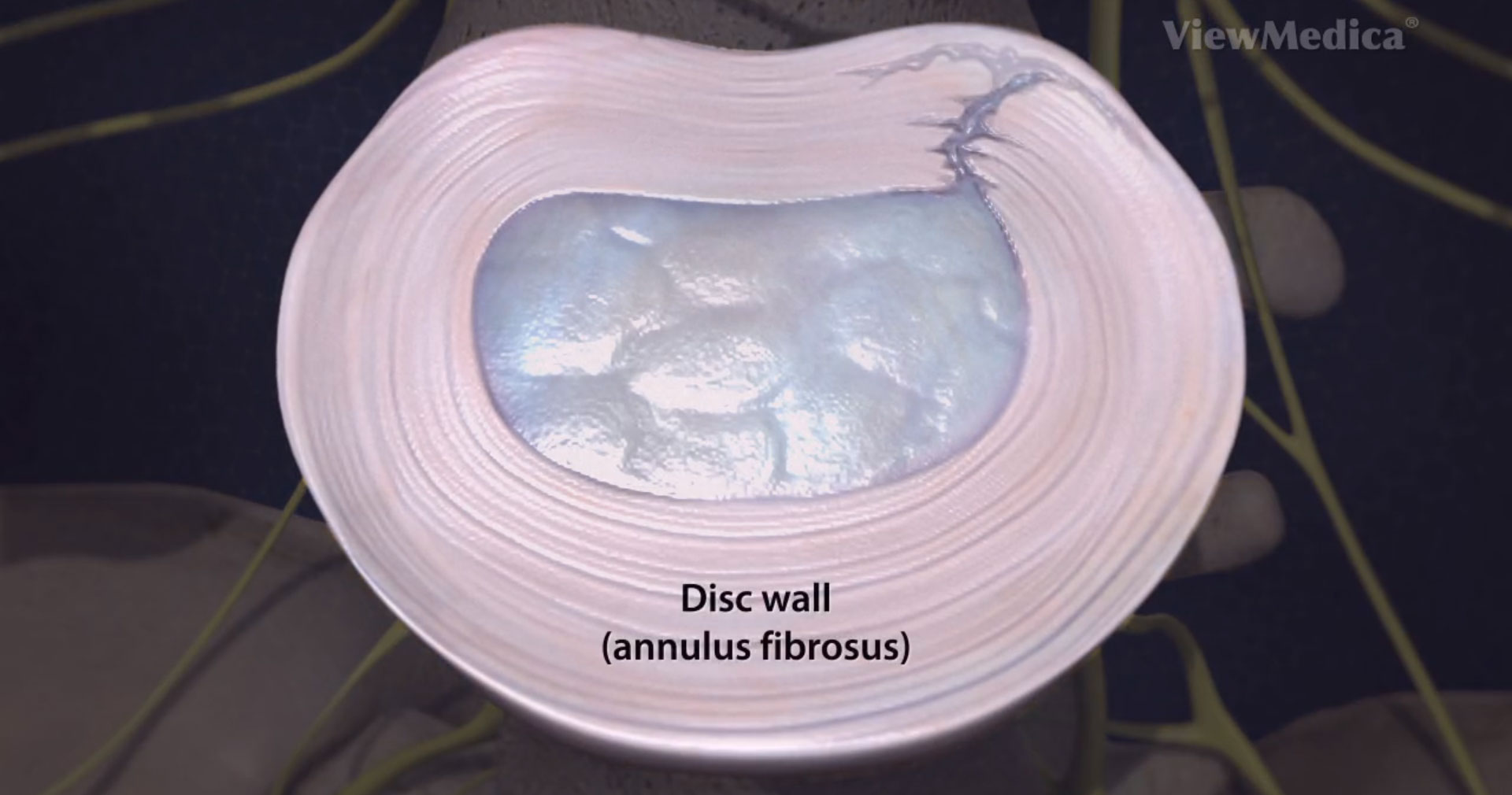 degenerative-disc-disease
