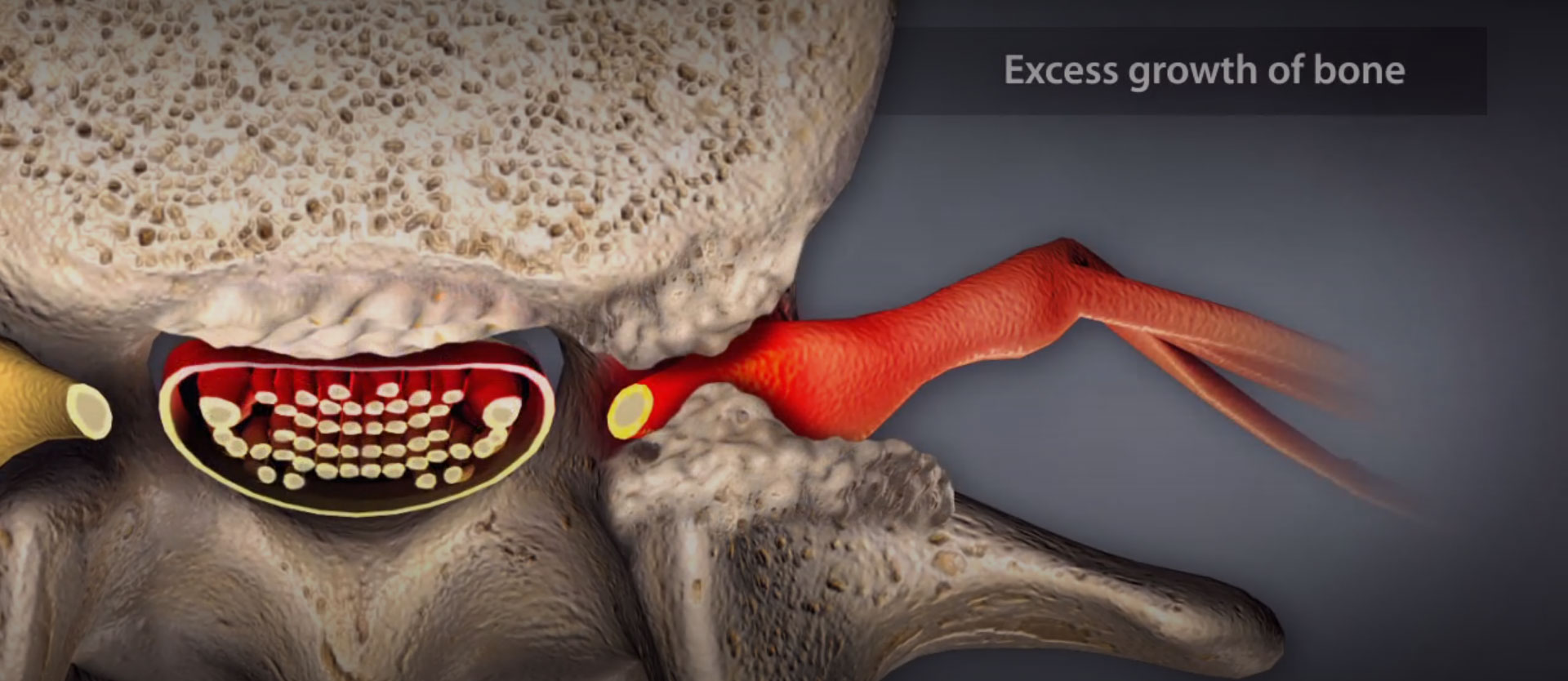 excess-growth-of-bone